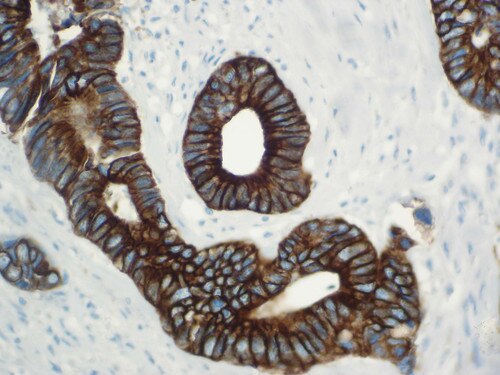 IHC of cytokeratin 19 on an FFPE Colon Adenocarcinoma